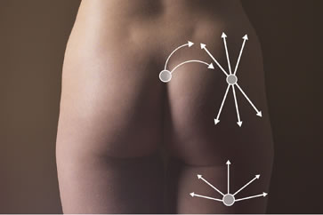 Liposucción en cirugía plástica